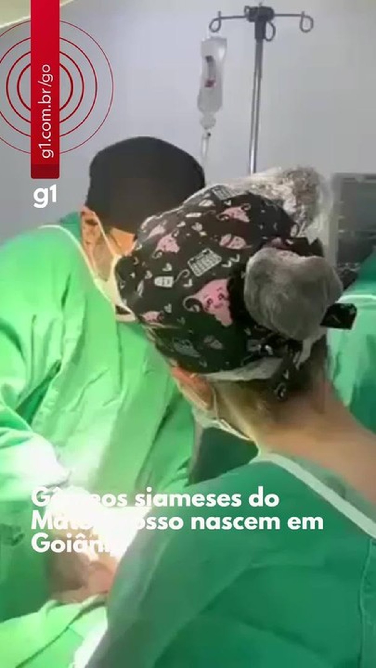 Gêmeos siameses do MT passarão por cirurgia de separação de emergência em Goiânia, diz assessoria