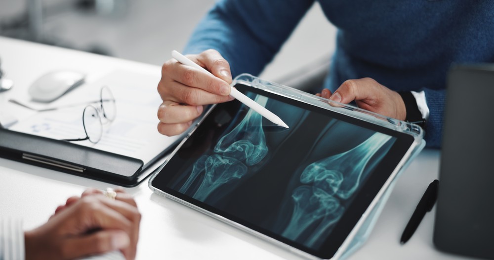 Fatores genéticos e hábitos de vida influenciam o risco de desenvolver osteoporose e fraturas