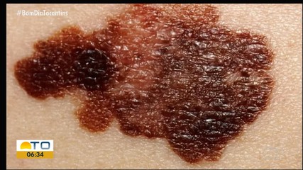 Bom Dia responde dúvidas dos telespectadores sobre câncer de pele