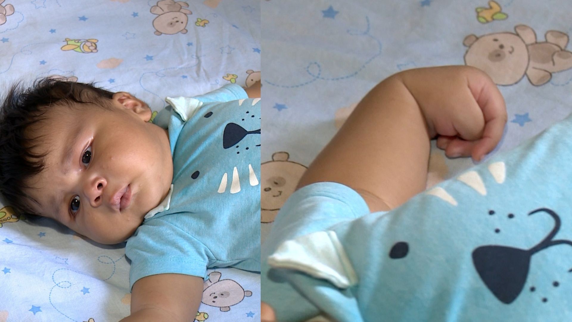 Bebê gigante de 6,5 kg faz fisioterapia para tentar recuperar movimento do braço deslocado no parto