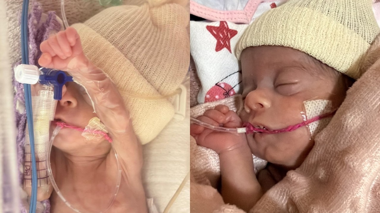 'Guerreirinha': bebê que chegou a pesar 620 gramas supera fase crítica após mais de 60 dias na UTI neonatal