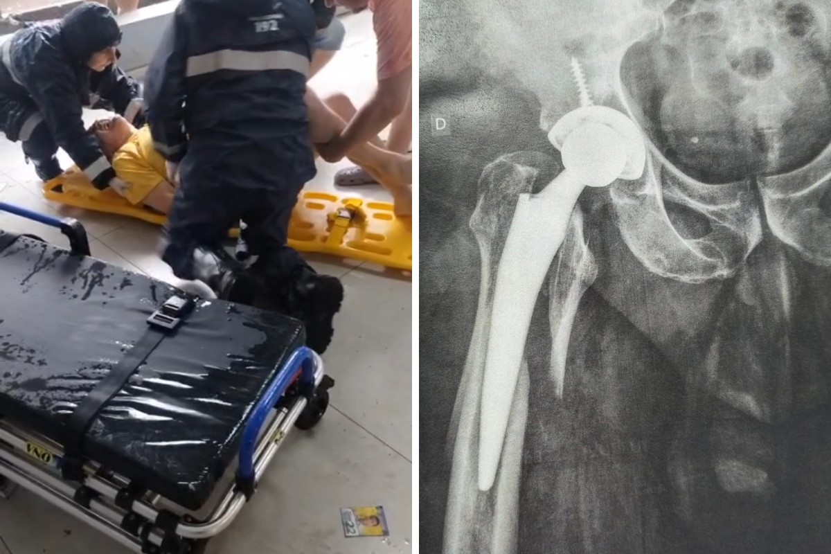 Homem com prótese no fêmur é internado após escorregar em santinhos durante eleição no interior de SP