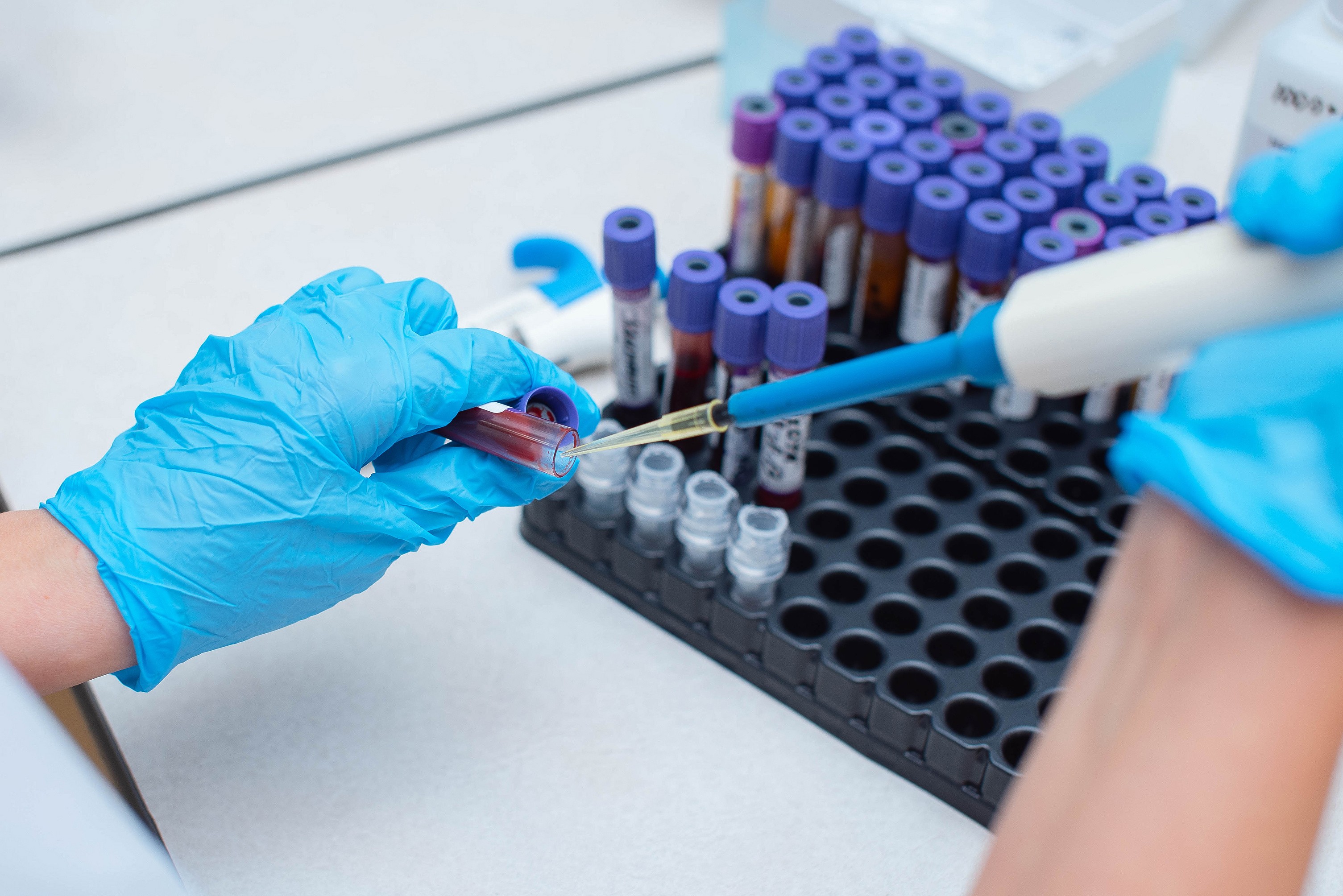 Exame de sangue testado no Brasil detecta Alzheimer com mais de 90% de precisão e pode reduzir custo do diagnóstico em até 10 vezes