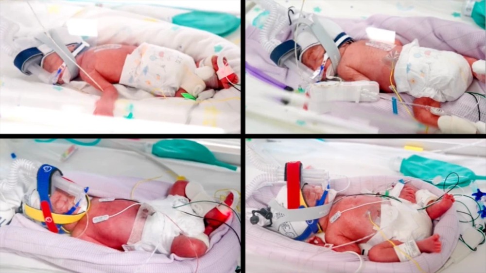 Mulher australiana tem quadrigêmeas idênticas em gestação natural com compartilhamento de placenta inédito