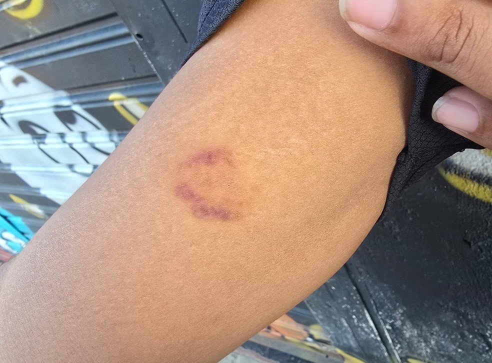 Morador mostra hematoma no braço — Foto: Arquivo pessoal