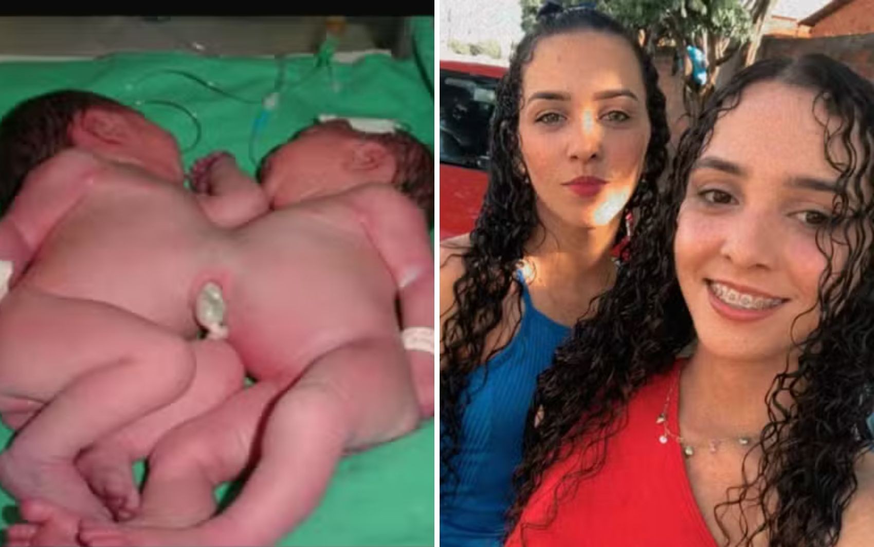 Raniela e Rafaela: Saiba como vivem gêmeas que nasceram unidas pelo abdômen e passaram por cirurgia de separação em 2002