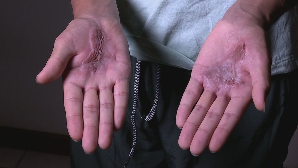 Uma adolescente de 17 anos, vítima da tortura, teve as mãos e língua queimadas. — Foto: TV Globo