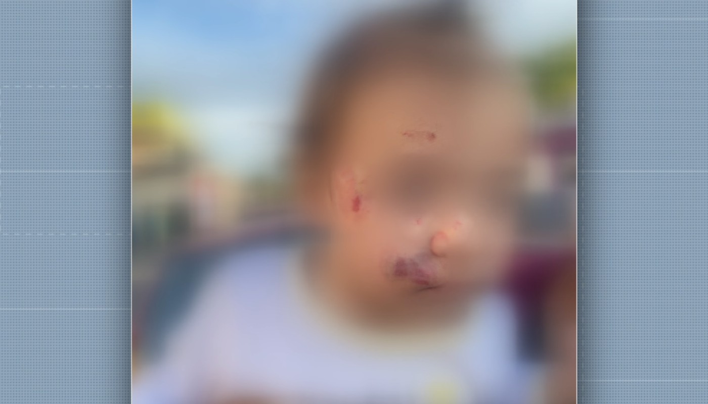 Creche de Sumaré é descredenciada pela Prefeitura após bebê de um ano sofrer lesões no rosto