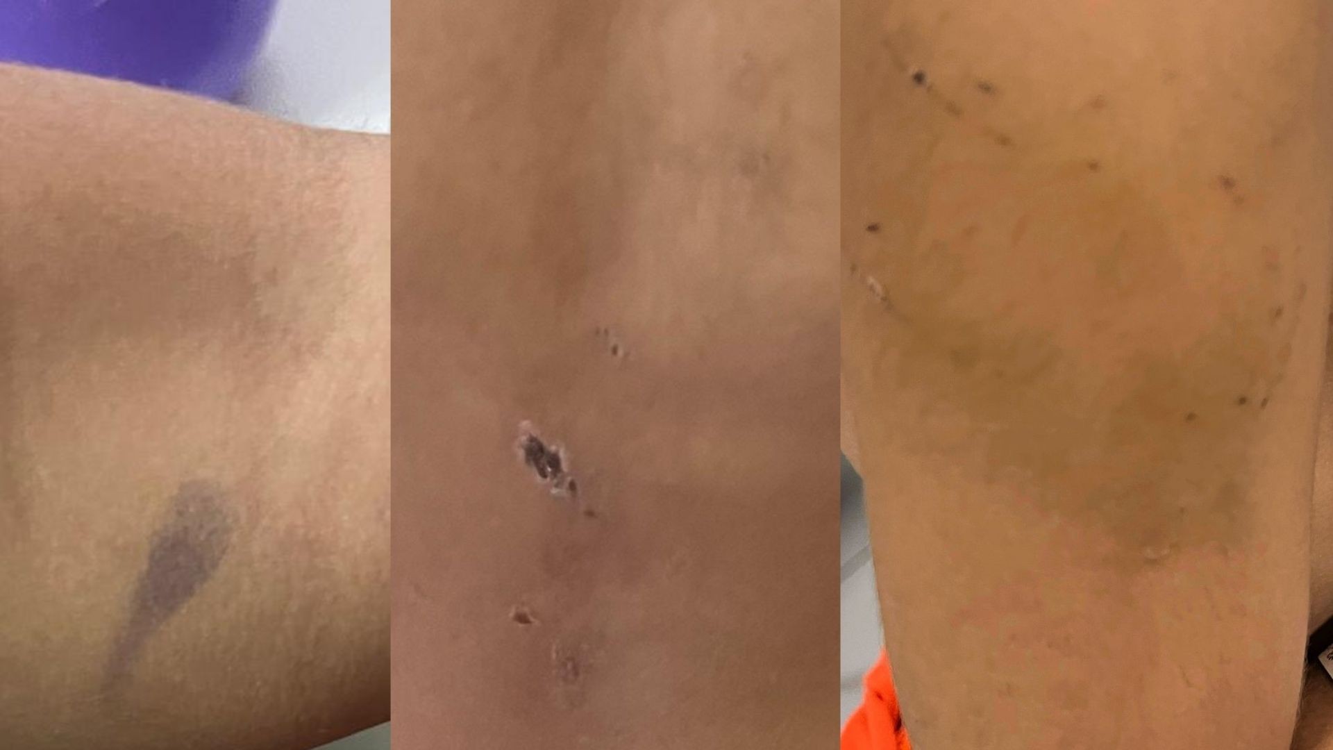 Criança de 4 anos é espancada por pai e madrasta em Olinda e levada a hospital com queimaduras de cigarro