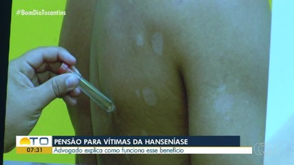 Pessoas vítimas da hanseníase podem ter direito à pensão; veja como ter acesso