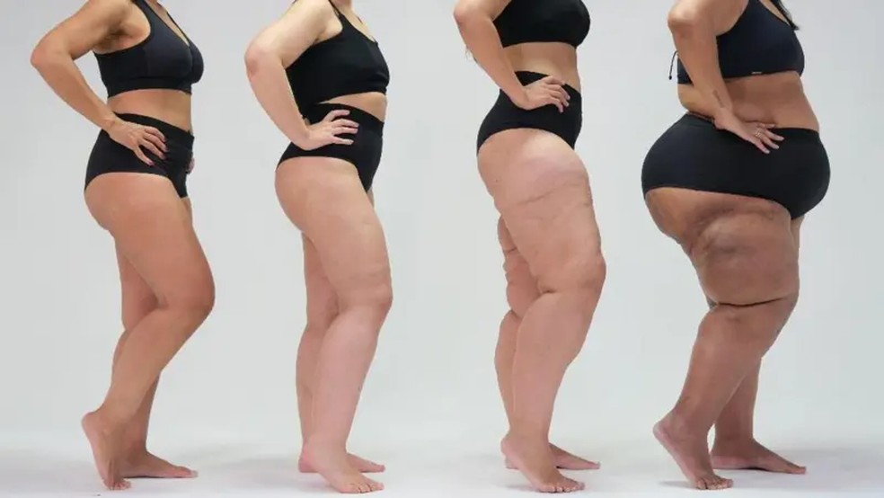 Aproximadamente 10% das mulheres em todo o mundo são afetadas pelo lipedema, uma condição que é significativamente mais comum no sexo feminino. No Brasil, esse número corresponde a mais de 10 milhões de pessoas — Foto: Crédito: ONG Movimento Lipedema/Conheça Lipedema