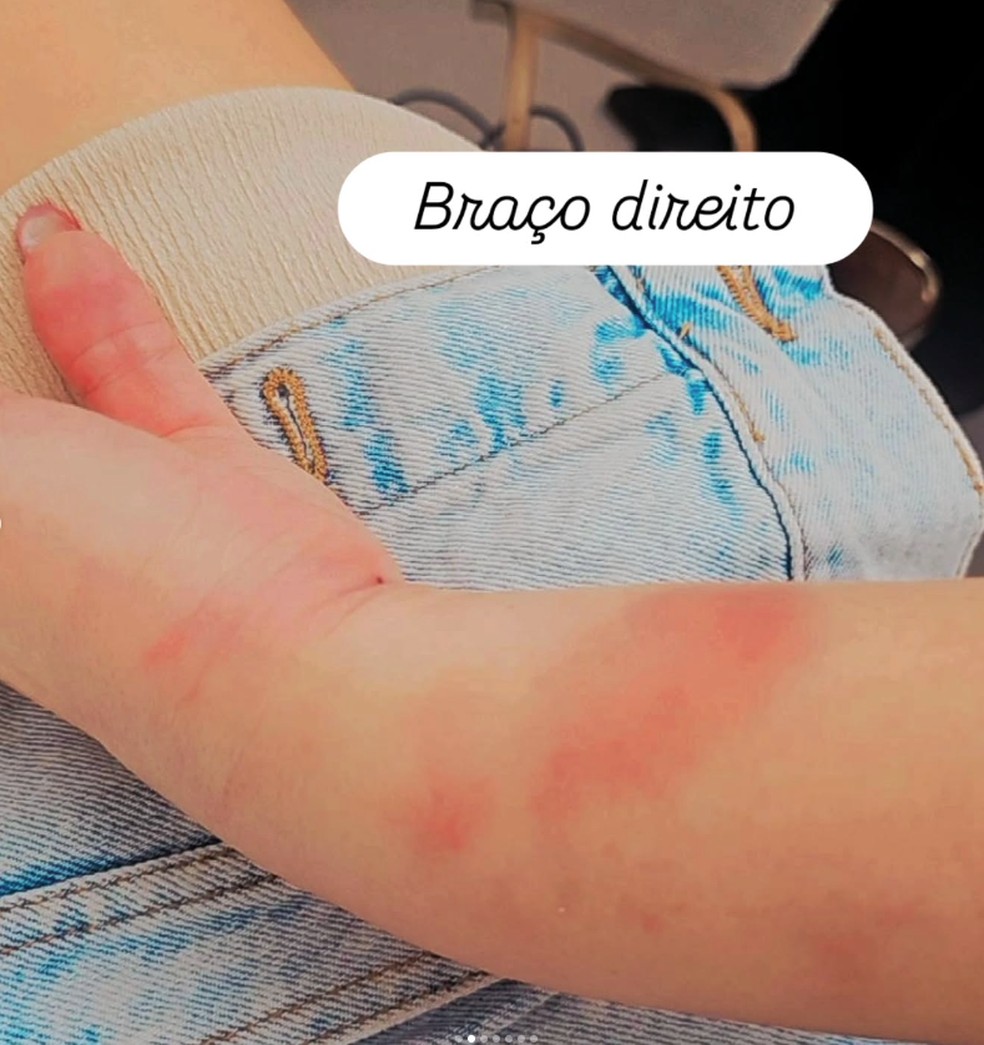Advogada brasileira mostra hematomas no braço direito após afirmar ter sido agredido pela polícia no aeroporto de Porto — Foto: Instagram/Reprodução