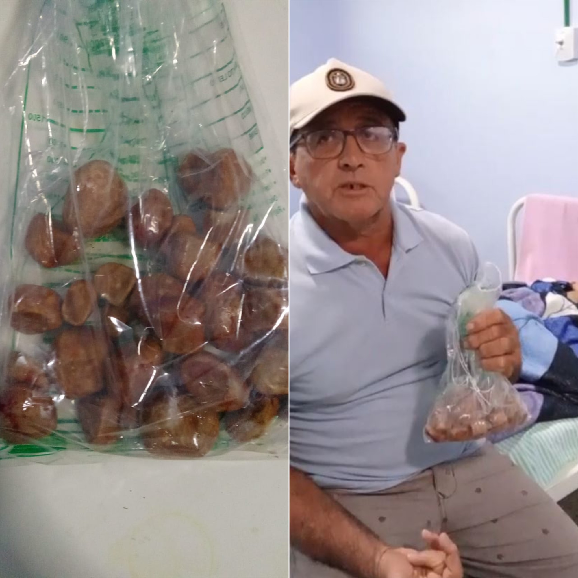 Idoso tem quase 30 pedras retiradas da bexiga em hospital no RN
