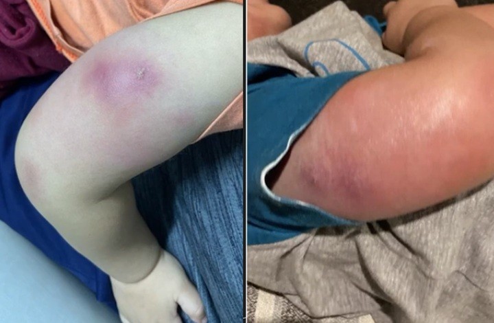 Menino de 1 ano é internado com infecção grave após tomar vacinas em posto de saúde em Maceió