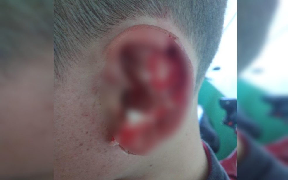 Estudante teve parte da orelha arrancada — Foto: Arquivo pessoal/Poliana Aparecida 