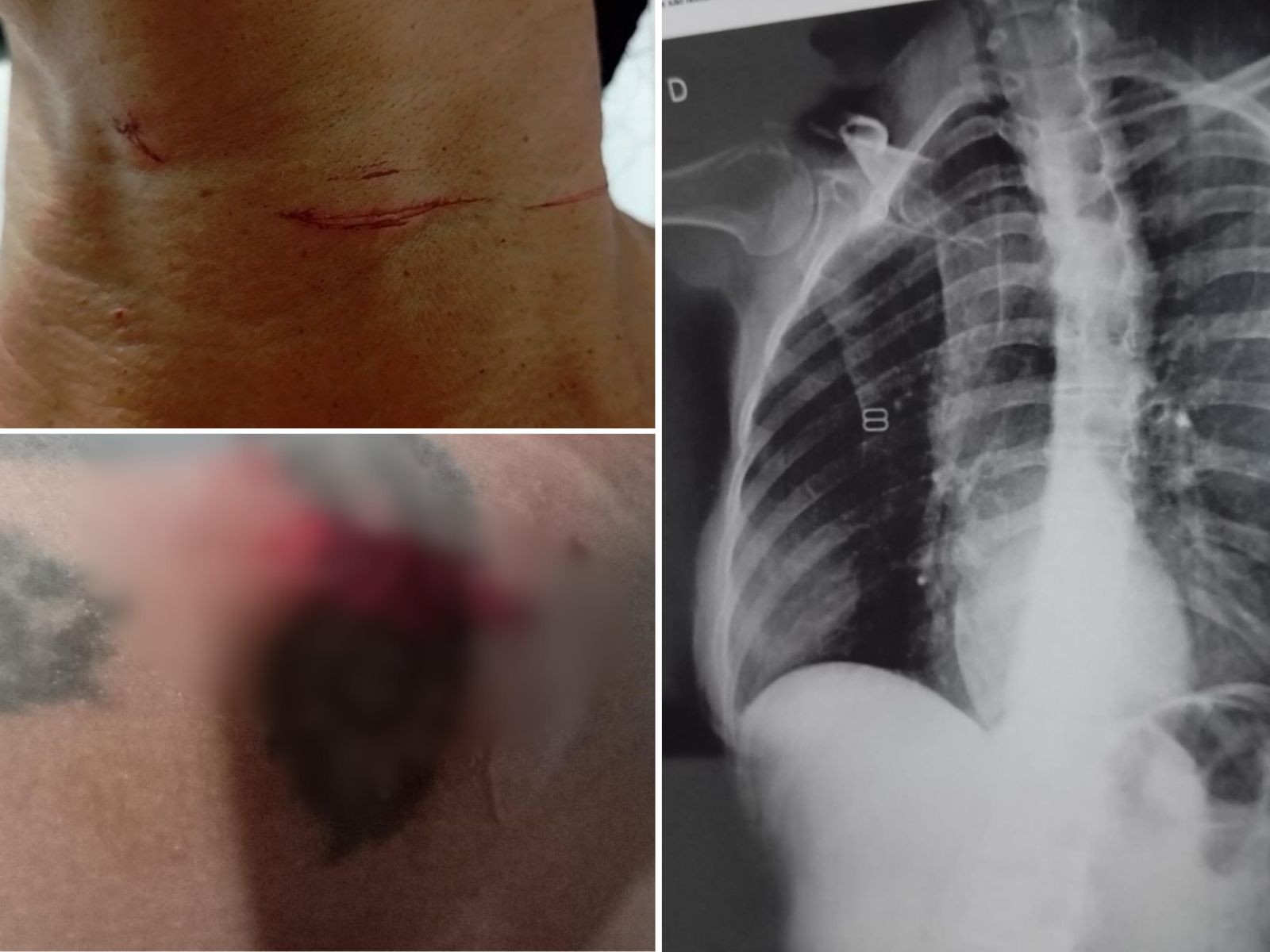 Mulher se joga da moto após ser atingida por linha com cerol e fratura costelas: 'Teria morrido'