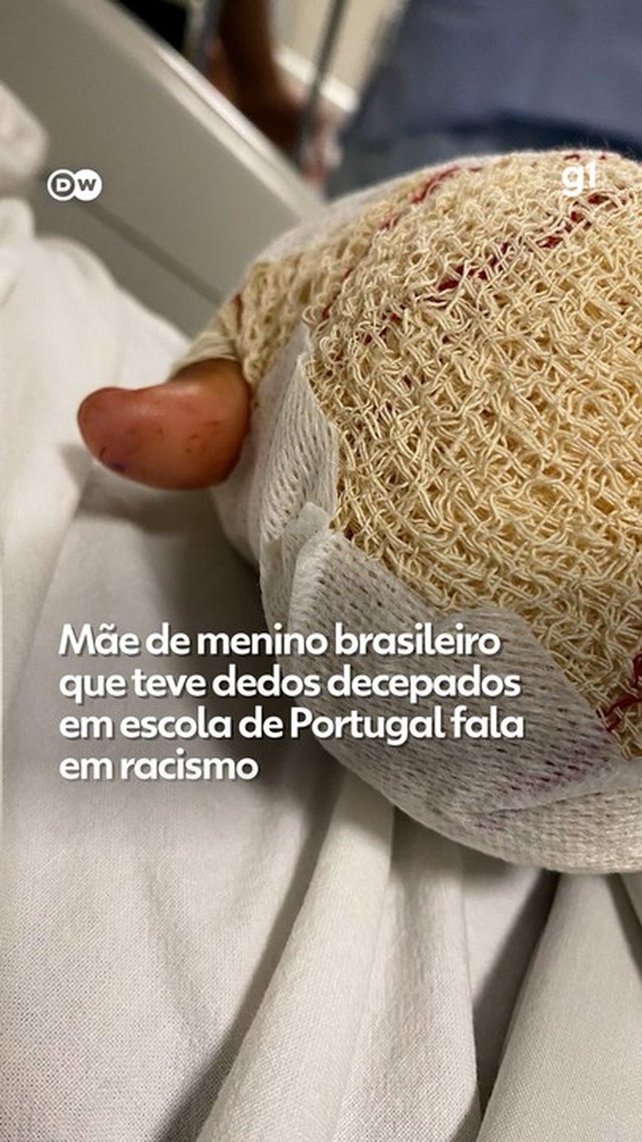 'Deceparam dedos porque ele é imigrante e negro', diz mãe de brasileiro de 9 anos atacado em escola de Portugal