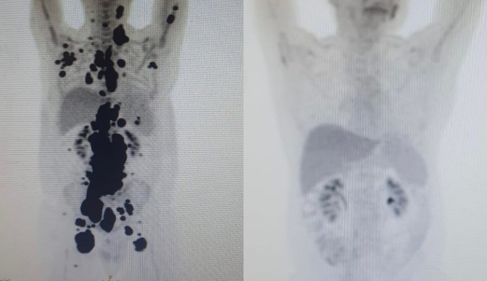 Exames mostram antes e depois de câncer de paciente; à direita, imagem mostra remissão da doença — Foto: Arquivo pessoal