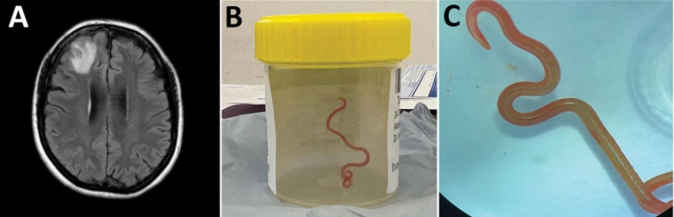 O verme de 8 centímetros de comprimento é da espécie Ophidascaris robertsi, que geralmente é parasita de cobras píton. — Foto: Reprodução/Emerging Infectious Disease