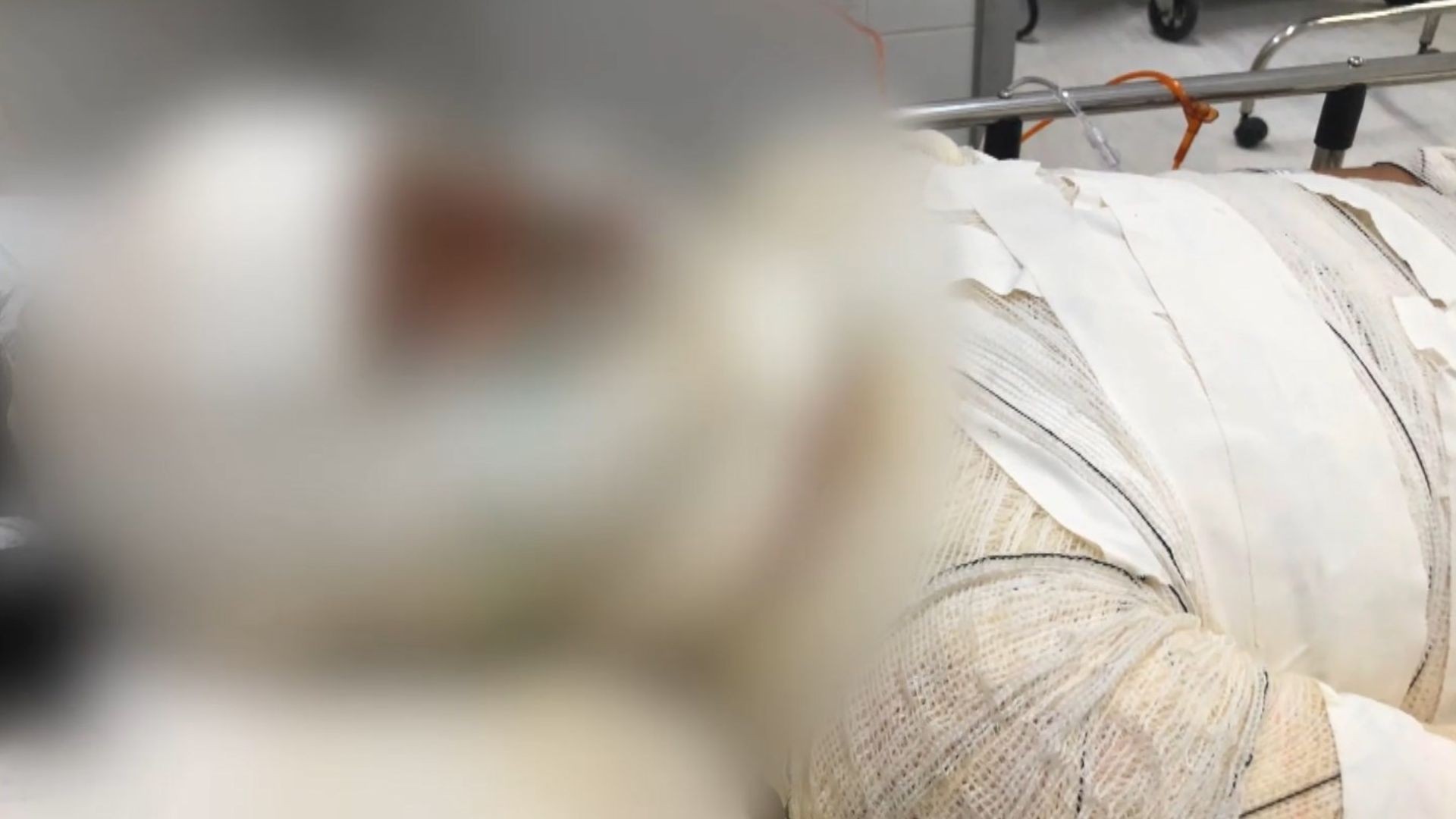 Menina é agredida, queimada e internada em estado grave em hospital de Vitória