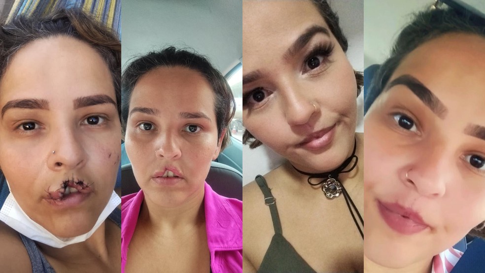 Evolu&ccedil;&atilde;o dos procedimentos cir&uacute;rgicos feitos por Natani Santos ap&oacute;s ter tido l&aacute;bio arrancado por c&atilde;o &mdash; Foto: Arquivo pessoal