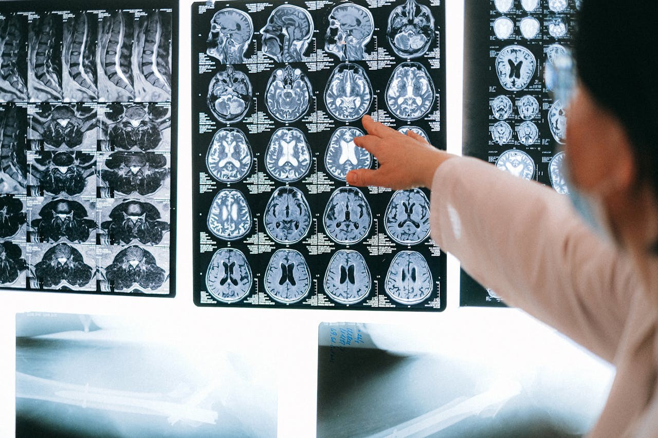 Inteligência Artificial agiliza diagnóstico de AVC