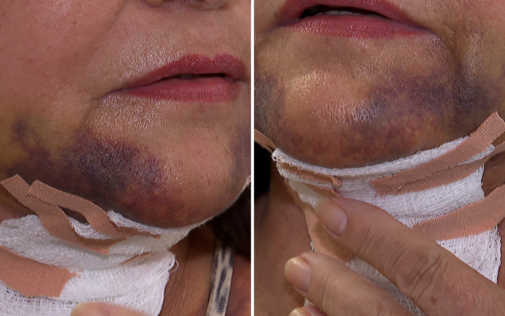 Laudo aponta deformidade estética permanente em paciente que fez procedimento estético com dentista em Ribeirão Preto, SP