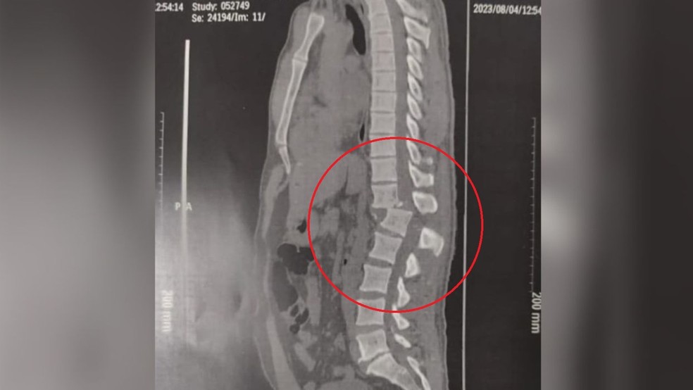 Tomografia mostra lesão na coluna de jovem lesão de jovem atingido por aparelho em academia de ginástica no Ceará — Foto: Reprodução/Arquivo pessoal