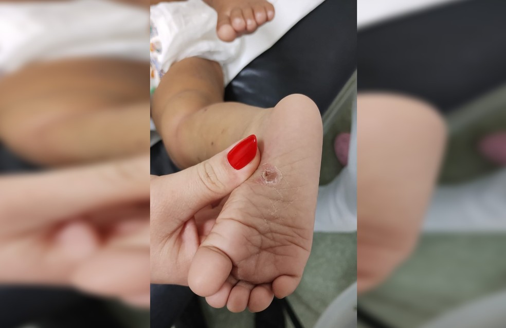 Criança atendida em hospital de Salto (SP) tinha queimadura no pé; marca pode ter sido feita por cigarro — Foto: Arquivo Pessoal
