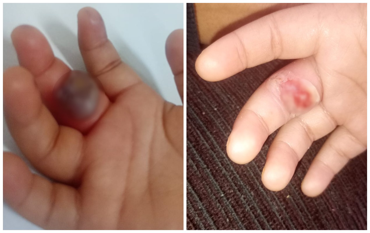 Menina de 2 anos tem dedo ferido após picada de aranha; mãe suspeita de creche em Sorocaba