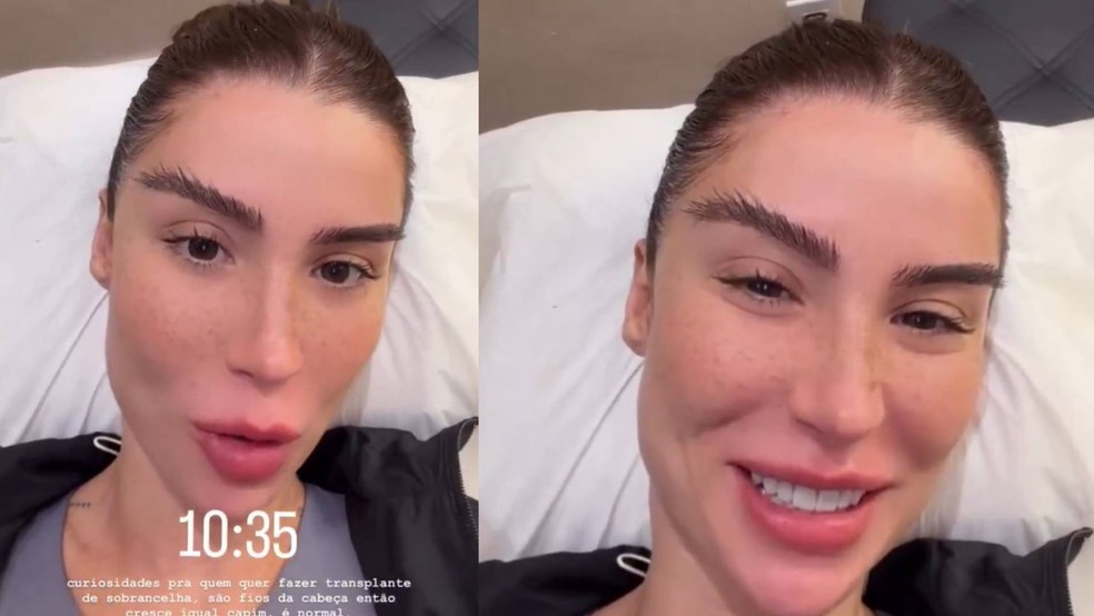 Boca Rosa faz transplante de sobrancelha; saiba como funciona e quais s&atilde;o as contraindica&ccedil;&otilde;es &mdash; Foto: reprodu&ccedil;&atilde;o redes sociais