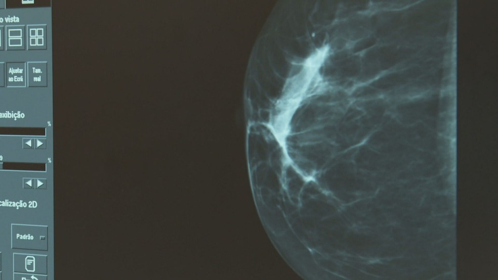 Câncer de mama está sendo diagnosticado com maior frequência que o comum em mulheres abaixo dos 40 anos — Foto: Reprodução/Jornal Hoje
