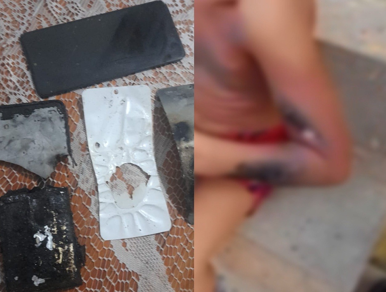 Menino de 6 anos tem corpo queimado após celular explodir enquanto jogava videogame no Recife