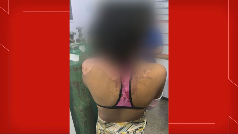 VÍDEO: Jovem de 14 anos é queimada com água quente pela tia por causa de ciúmes no DF