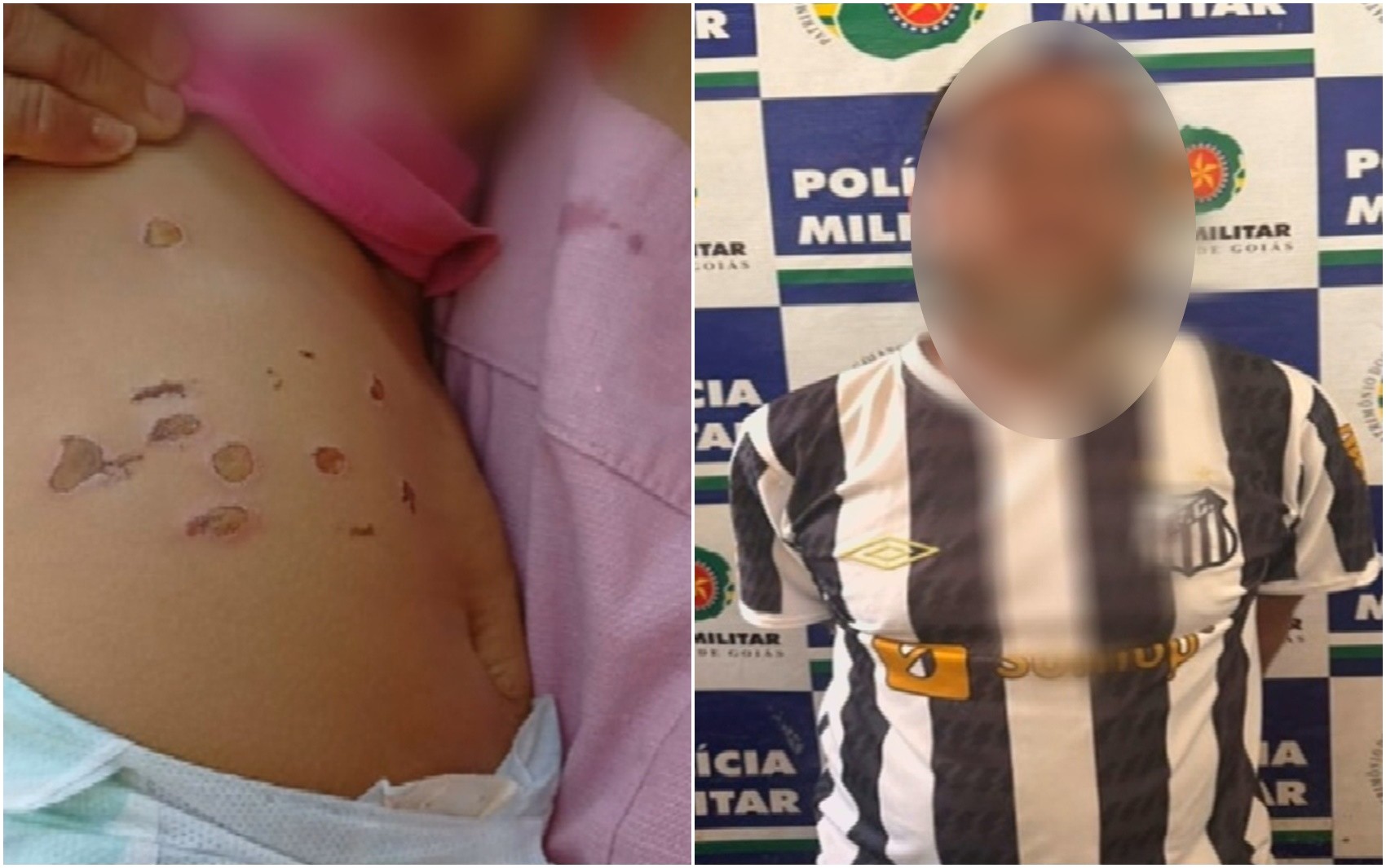 Bebê é levada ao hospital com marcas de queimaduras de cigarro, e companheiro da mãe é suspeito das agressões
