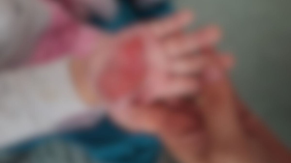 Mulher é investigada por queimar mão de enteada de 2 anos com colher quente para 'castigá-la' em SC