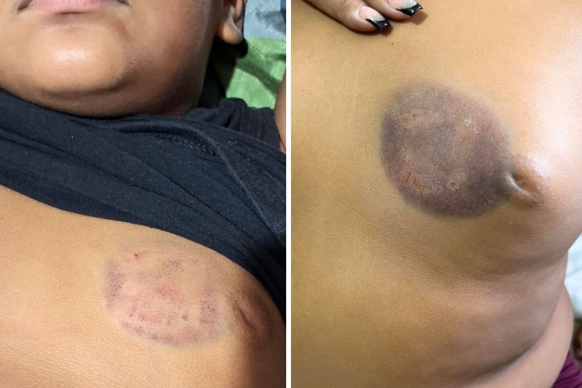 Menino de 7 anos é mordido no peito, agredido por alunos e medicado com  antidepressivo após ataques em escola