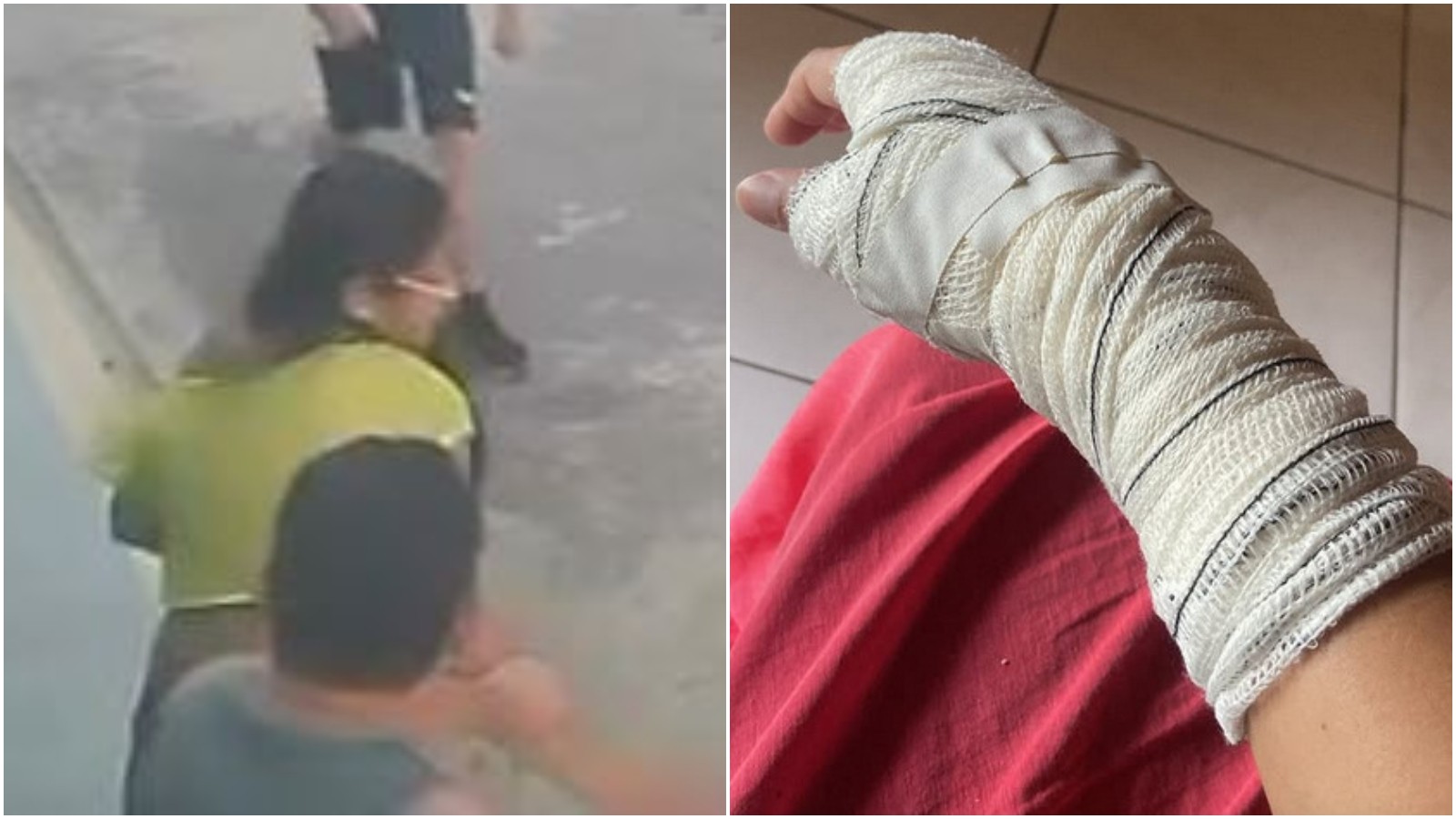 Mulher agredida por tutor de pitbull ao defender cães teve torção no tendão: 'Pegou minha mão e virou'