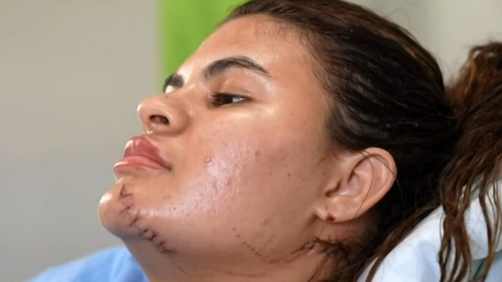 Ana Clara teve as mãos decepadas pelo cunhado em tentativa de feminicídio em Quixeramobim. — Foto: TV Globo/Reprodução