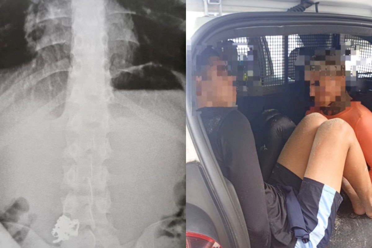 Ladrão engole correntinhas de ouro após roubo em Guarujá, SP, e peças aparecem em raio-X