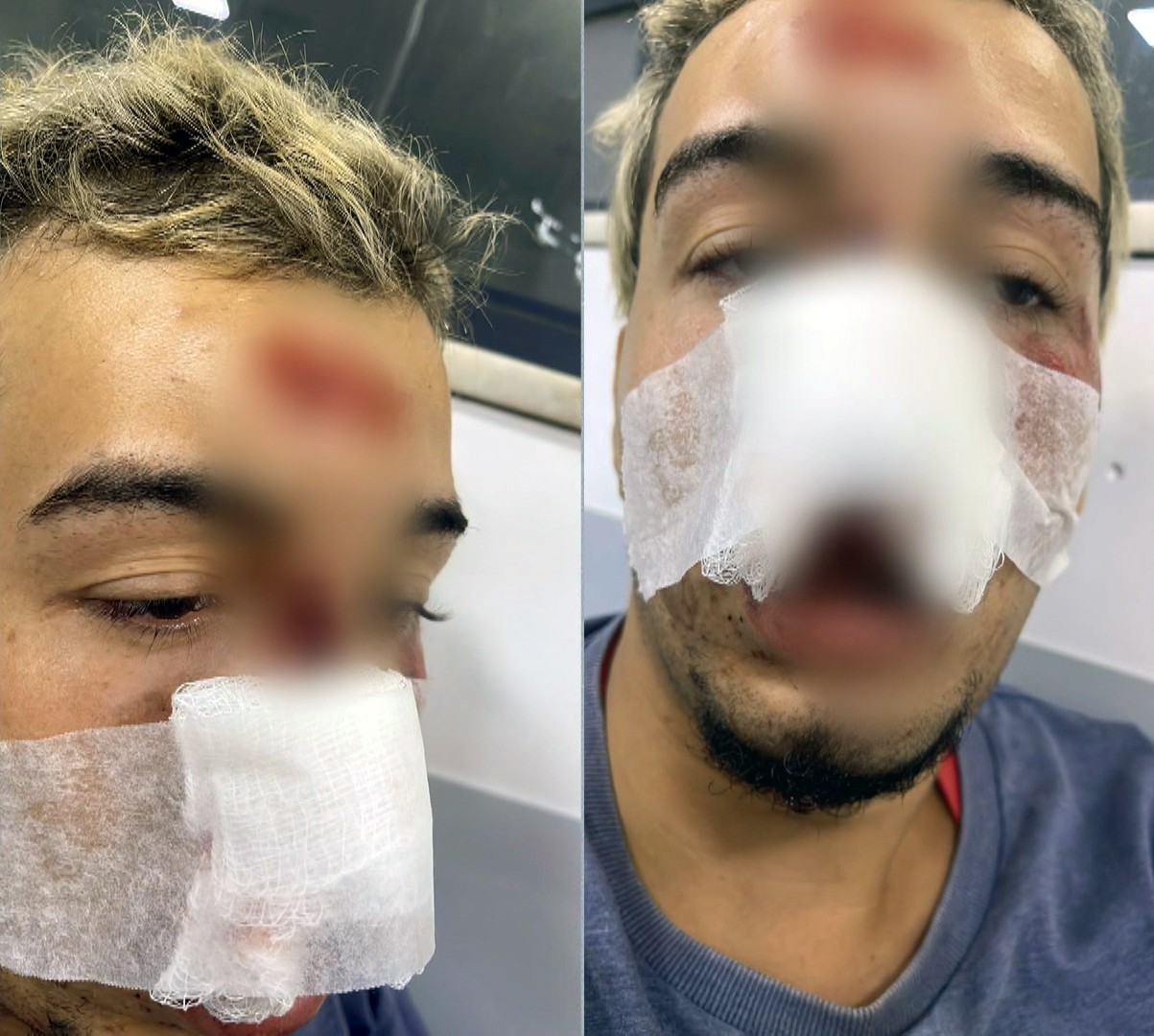 Ciclista perde dentes ao cair de bicicleta em buraco em Japeri