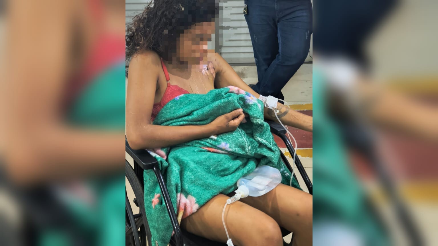 Mulher sofre queimaduras após cunhada jogar óleo quente durante briga em Santarém