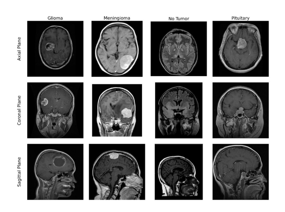 IA desenvolvida em pesquisa da Unifal ajuda a diagnosticar tumores cerebrais — Foto: Unifal/Divulgação