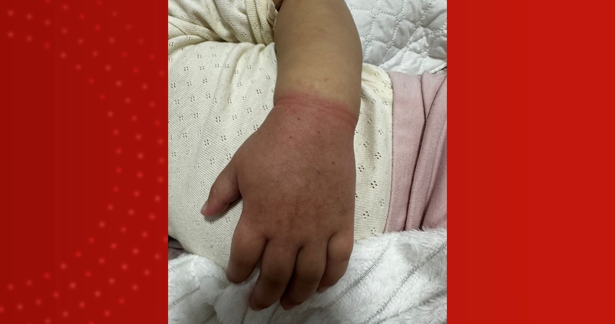 Urgente! Elástico de cabelo quase causa tragédia: Criança de 2 anos pode ter perdido o braço