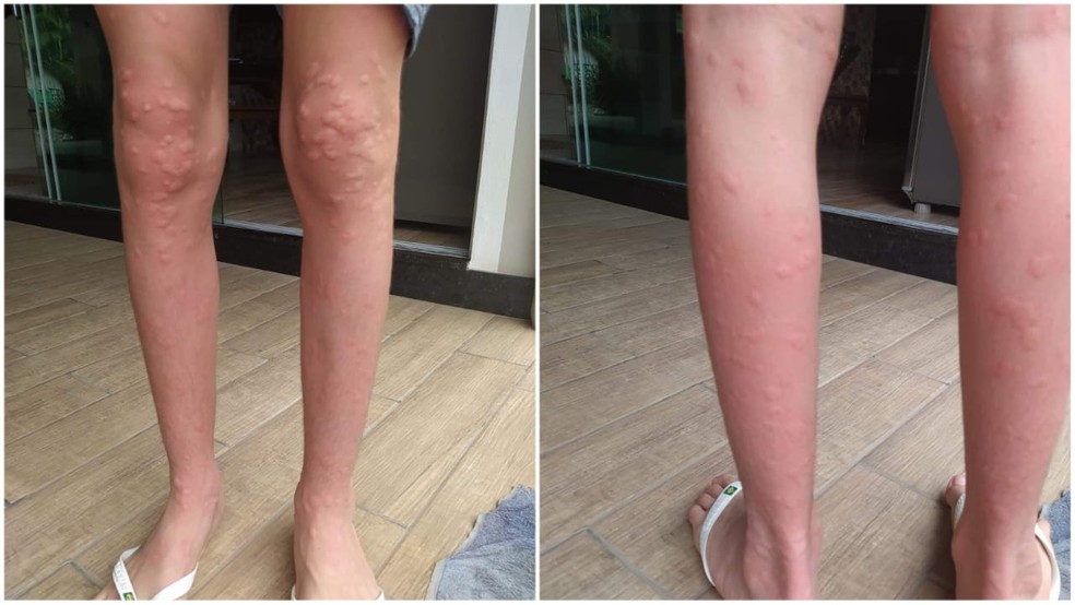 Picadas do inseto maruim em morador de Luiz Alves — Foto: Jaqueline Fischer/Arquivo pessoal