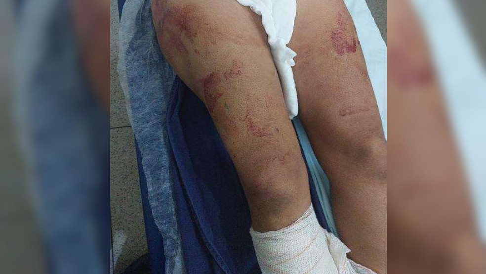 Mulher tem dedo quebrado e sofre cortes na cabeça após ser agredida com pá por homem em Castilho (SP) — Foto: Divulgação