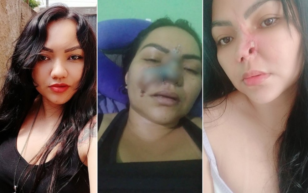 Mulher Madura, Antes E Depois Da Cirurgia Plástica, Operando Em
