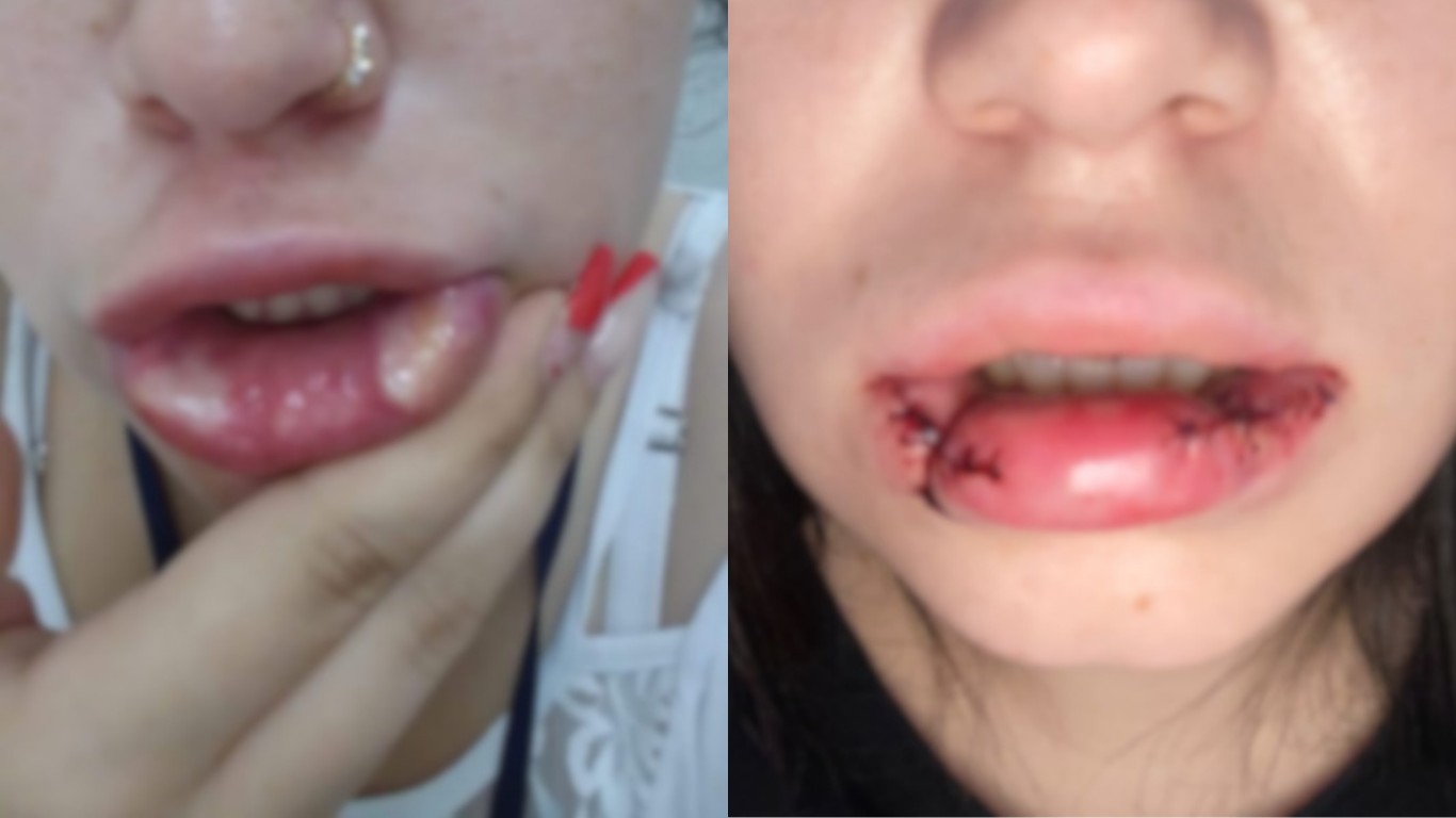 'Quase perdi a boca': mulher tem necrose após receber PMMA sem saber em SC; empresária é condenada