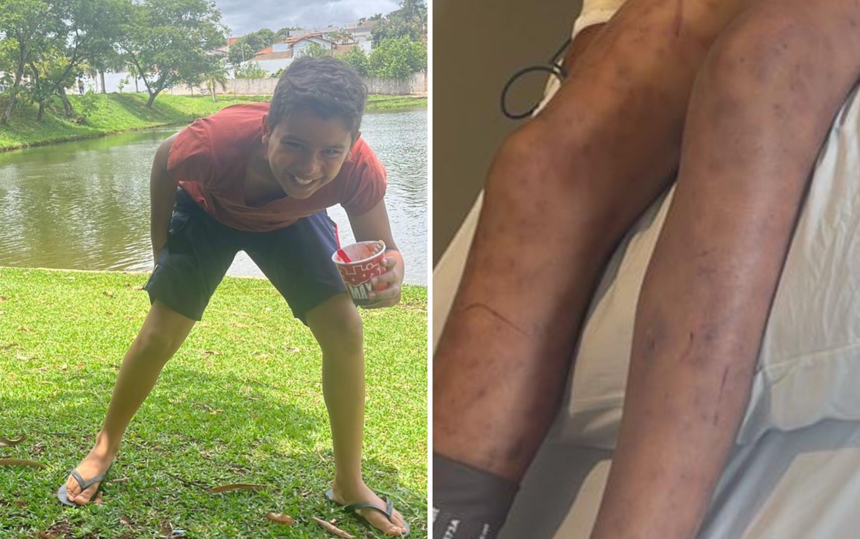 Menino picado por abelhas da cabeça aos pés brincava em mata quando foi atacado: ‘Estavam rodando na cabeça dele’