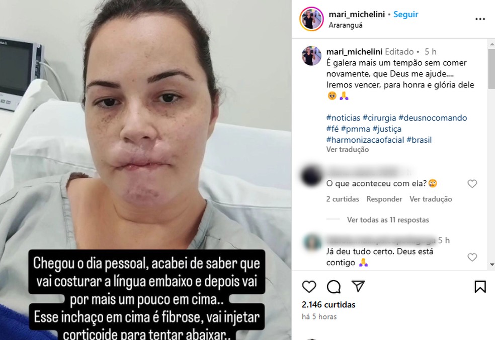 Mariana Michelini anunciou nova cirurgia em rede social — Foto: Redes sociais/ Reprodução
